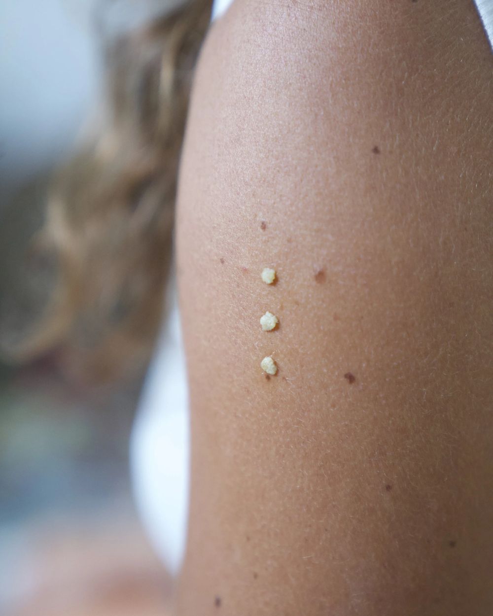 Kambo points applied on the upper arm